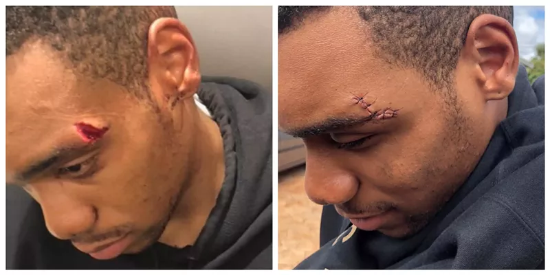Image: Jordan Bennett needed stitches after he says he was thrown to the ground by a deputy at Blanche Ely High School.