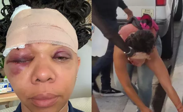 Image: Woman Struck by Rubber Bullet While Protesting Police Brutality Sues City of Fort Lauderdale